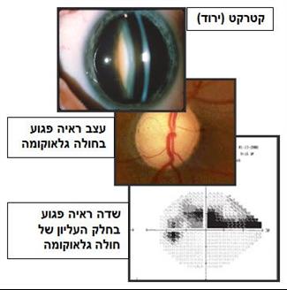 ניתוחי קטרקט לחולי גלאוקומה