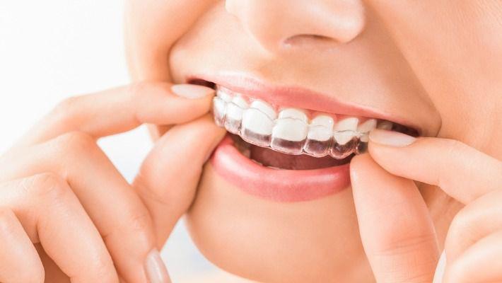 אישה מחייכת ומציגה את הקשתיות השקופות המשמשות ליישור שיניים