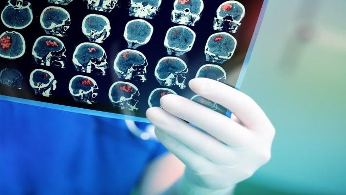 רופא בוחן צילום MRI של חולה שעבר שבץ 