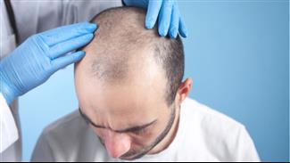 השתלות שיער מתרומת שיער גוף :האם זה אפשרי?