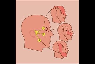 פחות תופעות לוואי וסיכונים: טיפול בבוטוקס לתסמונת העצב המשולש