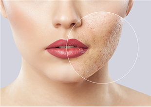 מהי מחלת ההידרדניטיס סופורטיבה וכיצד ניתן להקל על הסובלים ממנה?