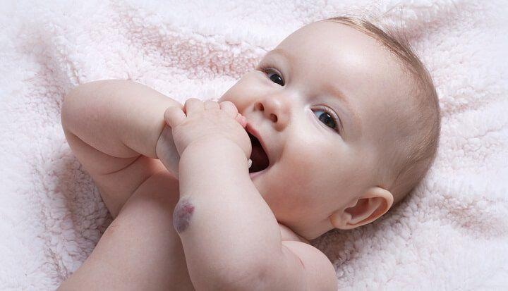 תינוק עם המנגיומה בזרוע