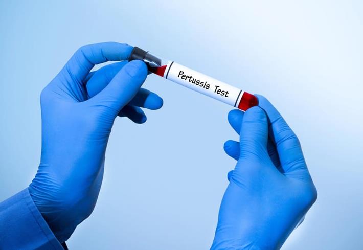 יד אוחזת במבחנה לבדיק, נוגדני שעלת  PERTUSSIS IGA IGG