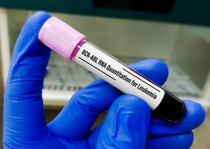 יד אוחזת במבחנה לאחר לקיחת דם לצורך בדיקת PCR לגילוי גן BCR-ABL