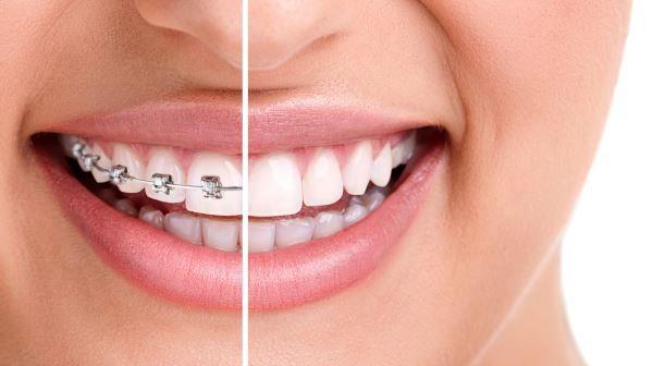 אישה מחייכת כשעל חלק  מפיה יש גשר בשיניים